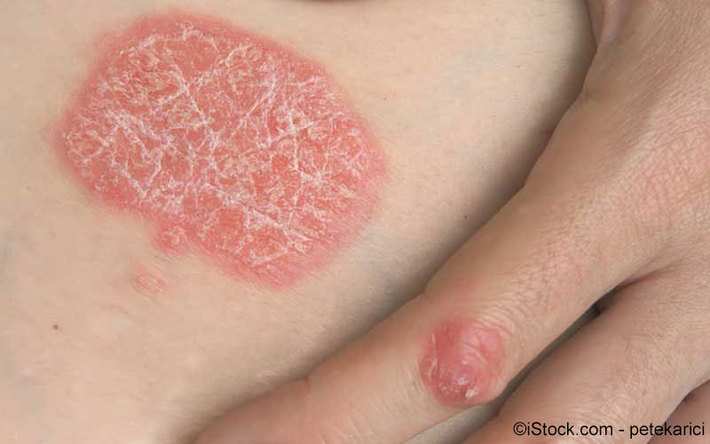Psoriasis Psoriasis